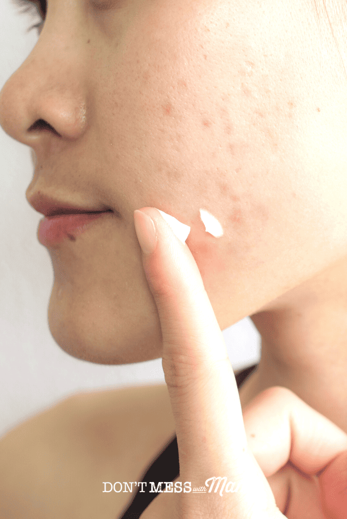 woman with acne scars applying cream